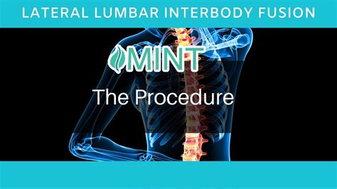 Lateral Lumbar Interbody Fusion In Dallas Tx The Procedure Dr Scott