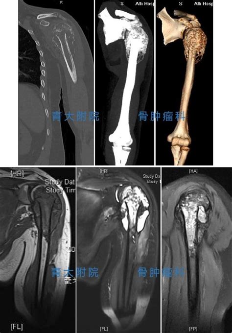 【典型病例】lars人工韧带重建恶性骨肿瘤切除后的软组织缺损郑炳鑫医生文章青岛大学附属医院崂山院区 微医