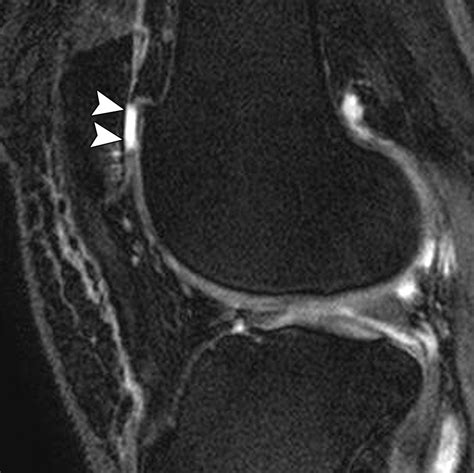 Articular Cartilage In The Knee Current Mr Imaging Techniques And