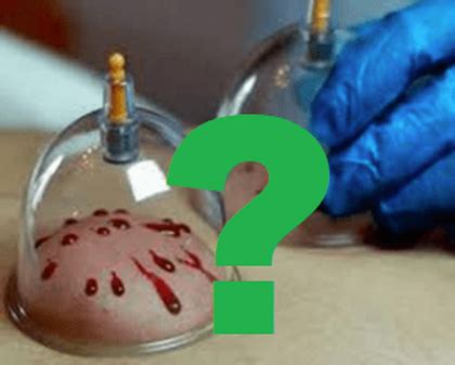 Why Hijama?