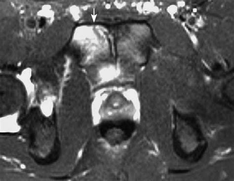 Athletic Pubalgia And “sports Hernia” Optimal Mr Imaging Technique And