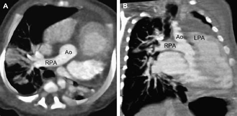 Right Hemitruncus A Axial Maximum Intensity Projection Image Shows