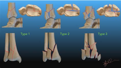 Ruedi And Allgower Classification Of Pilon Fractures Uw Emergency