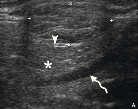 Case 1 Gray Scale A And Color Doppler B Ultrasound US