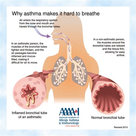 Asthma Library | AAAAI