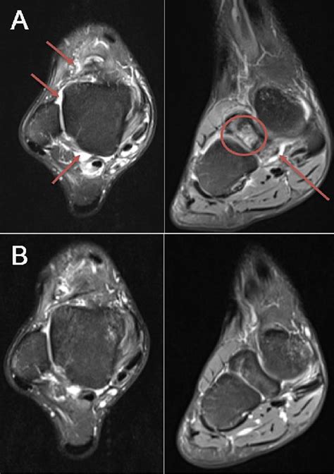 Magnetic Resonance Imaging Mri Of The Right Ankle A Grade On