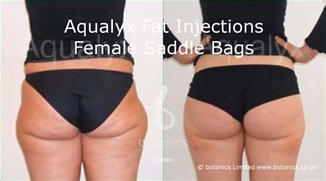 Aqualyx Fat Injections Before And After Botonics