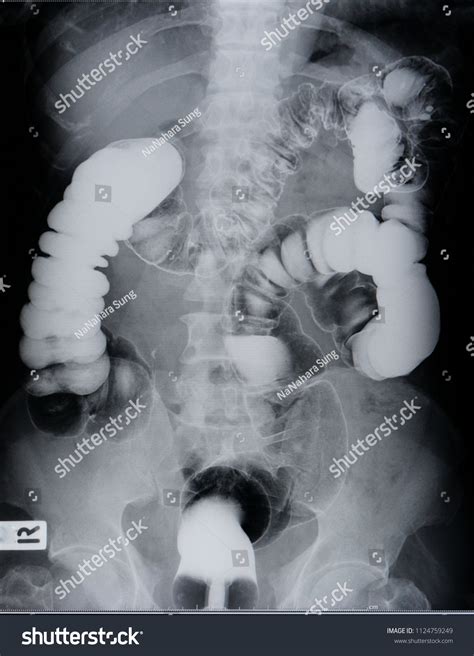 Barium Enema Radiology Double Contrast Stock Photo 1124759249 ...