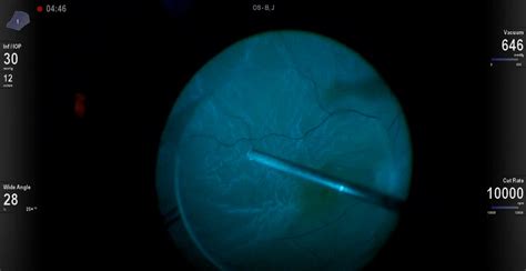 Epiretinal Membrane Peel Under PFO - Eyetube