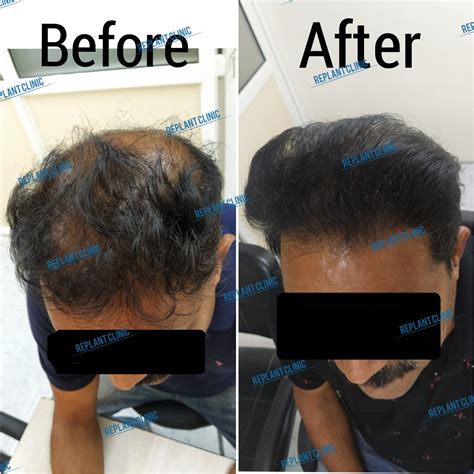 Gallery | Dr. Ketan's - Replant Skin Clinic and Hair Transplant Center