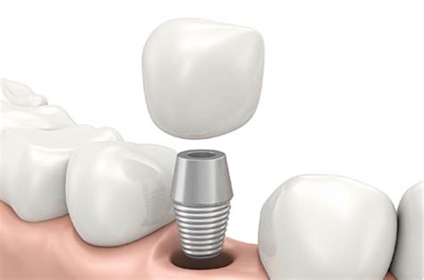 How Mini Dental Implants Can Restore Your Smile Infographic Dr