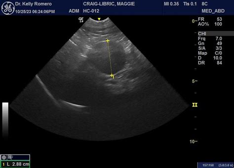 benign liver mass? - Members