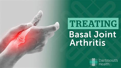 Basal Joint Arthritis Youtube