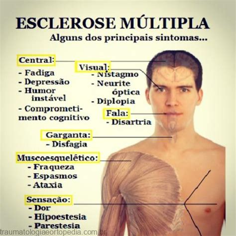 Esclerose M Ltipla Traumatologia E Ortopedia