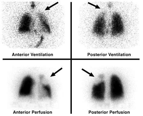 Lung Segments Vq