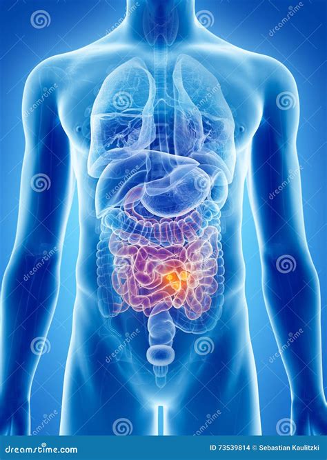 Small Intestine Cancer Stock Illustration Illustration Of Anatomical