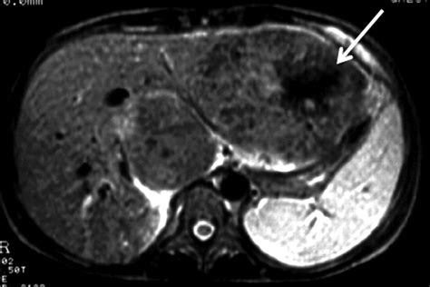 The Hypointense Liver Lesion On T2 Weighted Mr Images And What It Means