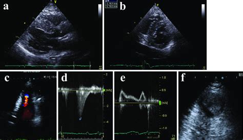 Figure2 The Echocardiogram Obtained At Admission Is Shown The