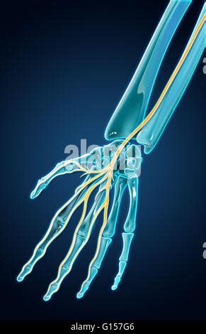 Ein D Modell Des Handgelenks Und Median Nerv Im Karpaltunnel Syndrom