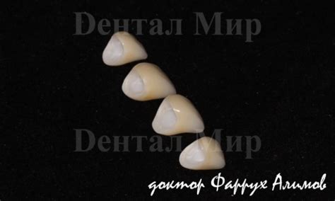 Коронки из диоксида циркония - ZrO2. Фото, отзывы. Стоимость ...