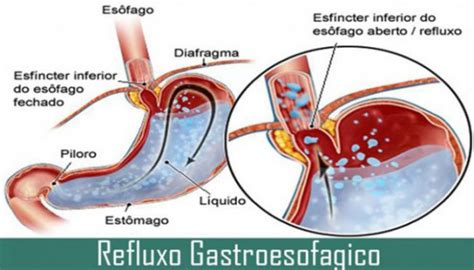 Oq É Refluxo Gastrico - Refluxo Gastrico