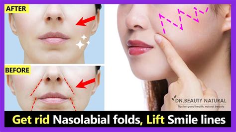 Get Rid Smile Wrinkles Laugh Lines Nasolabial Folds Lift Smile Lines