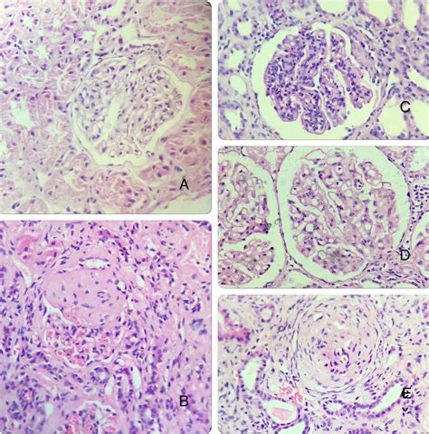 A Mesangial Proliferative Ln B Focal Segmental Ln C Diffuse Ln D