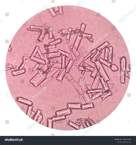 Urine Sediment Showing Struvite Crystals Squamous Stock Photo ...