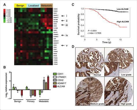 Alcam Is Overexpressed In Metastatic Prostate Cancer And Correlates