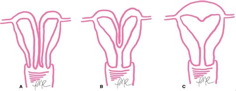 Uterine Duplication Anomalies Distinguishing Among Didelphy Topics In Obstetrics And Gynecology