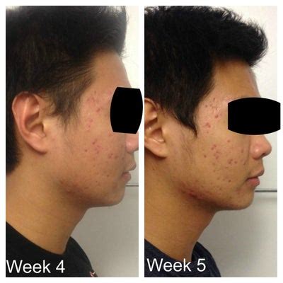 How effective is Accutane on acne? What are the side effects? (photo) Doctor Answers, Tips