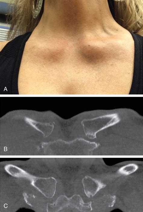 Open Management Of Atraumatic Disorders Of The Sternoclavicular Joint