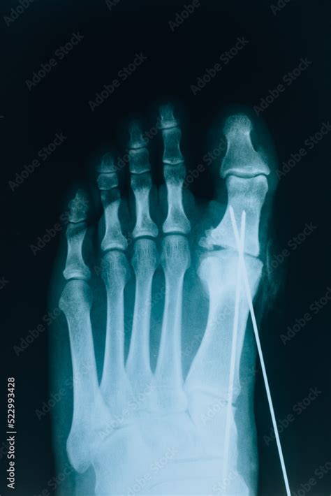 X-ray of the toes. Leg injury. Shot of the foot with pins Stock Photo | Adobe Stock