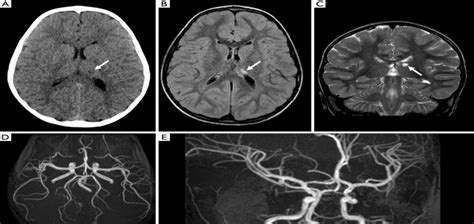 Comprehensive Guide to MRI Angiography of Brain and MRA of Brain