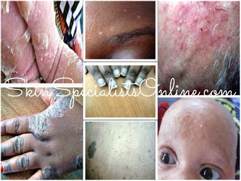 Skin Diseases Pictures and Symptoms - Skin Specialists Online