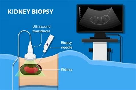 Kidney biopsy - Dr. Jyoti Bansode | Nephrologist In Navi Mumbai