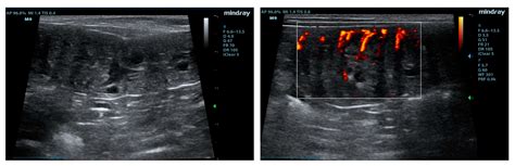 Cystic Endometrial Hyperplasia Ultrasound