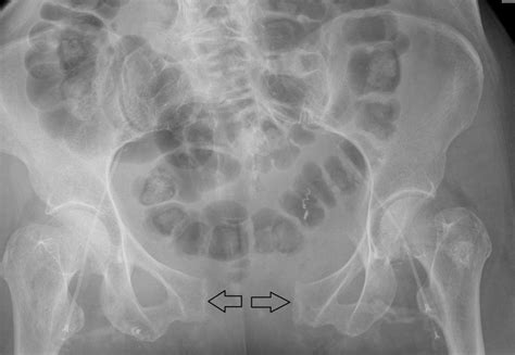 Disjonction de la symphyse pubienne Chirurgie Orthopédique et