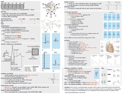 ECG Interpretation: All you need to know - Manual of Medicine