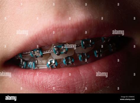 Brace Lip From Braces at Ruby Black blog