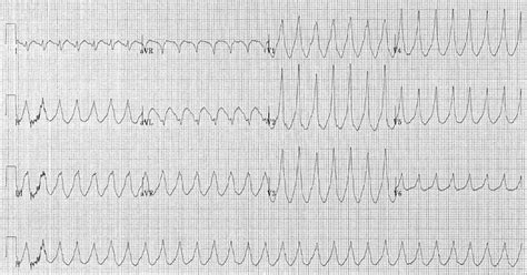 Ventricular tachycardia classification - wikidoc