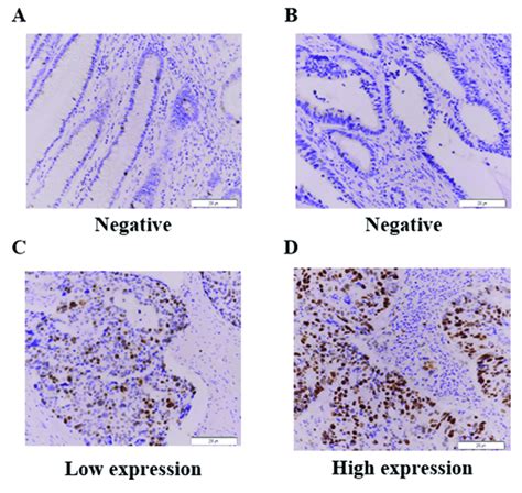 Immunohistochemistry For Hjurp Expression In Colorectal Cancer Tissues