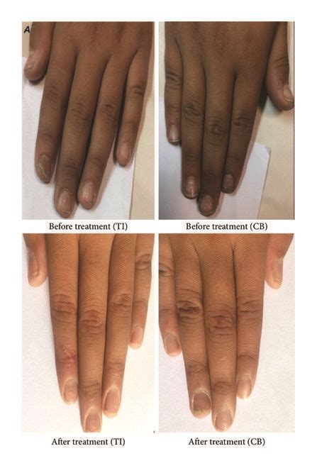 A A Patient With Nail Matrix Involvement Pitting B Patient With Download Scientific