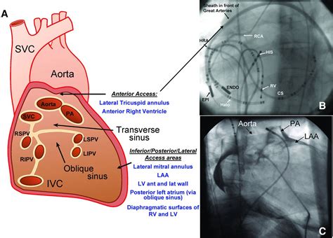 Epicardial Interventions In Electrophysiology Circulation