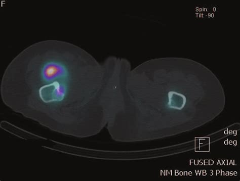 Tripple phase bone scan showed a focal region of mild to moderate ...