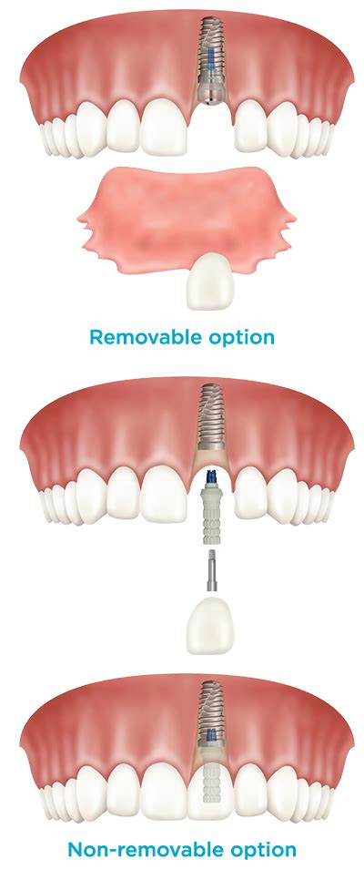 Front Tooth Replacement American Society Of Implant And