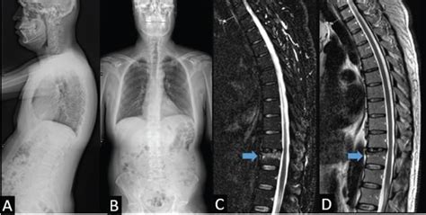 The Impact of Vertebroplasty on Sagittal Parameters in Traumatic ...