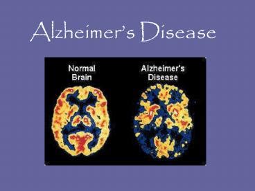 Ppt Alzheimers Disease Powerpoint Presentation Free To View Id