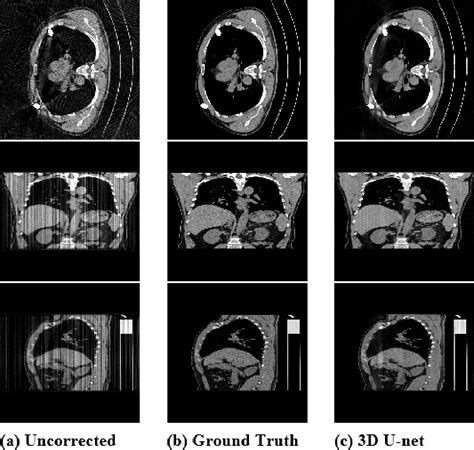 Figure From Initial Results Of Ct Volume Metal Artifacts Reduction