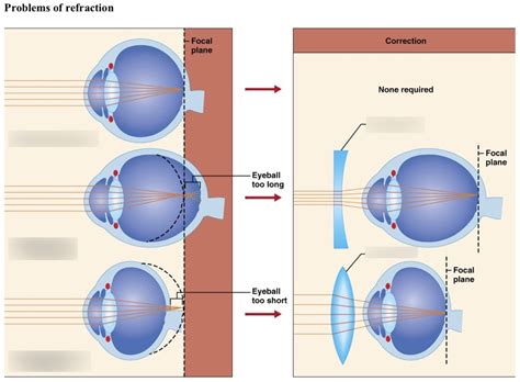 Emmetropic, myopic, hyperopic eye Diagram | Quizlet